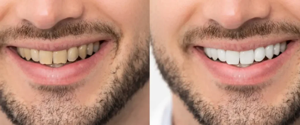 Teeth-Whitening-Myths-and-Facts-You-Should-Know