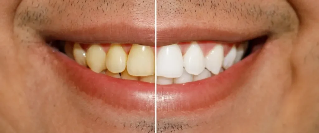 Teeth-whitening-procedures-at-marigold