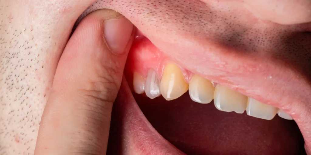 Swollen-Gums