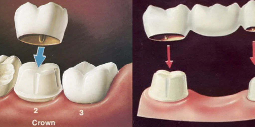 How-Dental-Crowns-Bridges-Can-Transform-Your-Oral-Health