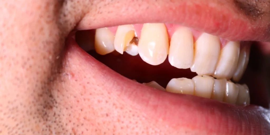 Signs-You-May-Need-a-New-Filling