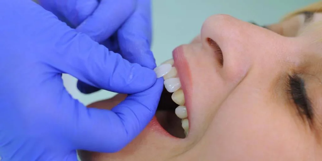 Where-to-Get-Dental-Crowns-Bridges-in-Abu-Dhabi