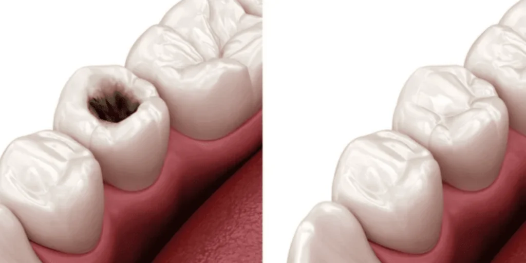 Why-Do-You-Need-a-Teeth-Filling