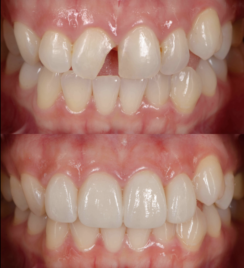 Composite Bonding Before and After