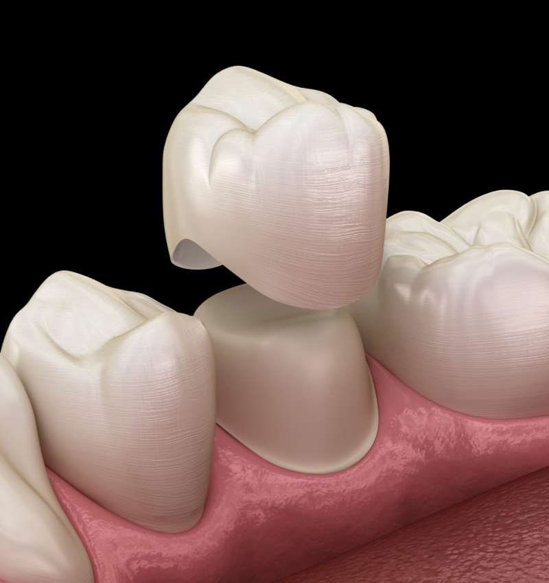 Best Tooth Crowns in Abu Dhabi