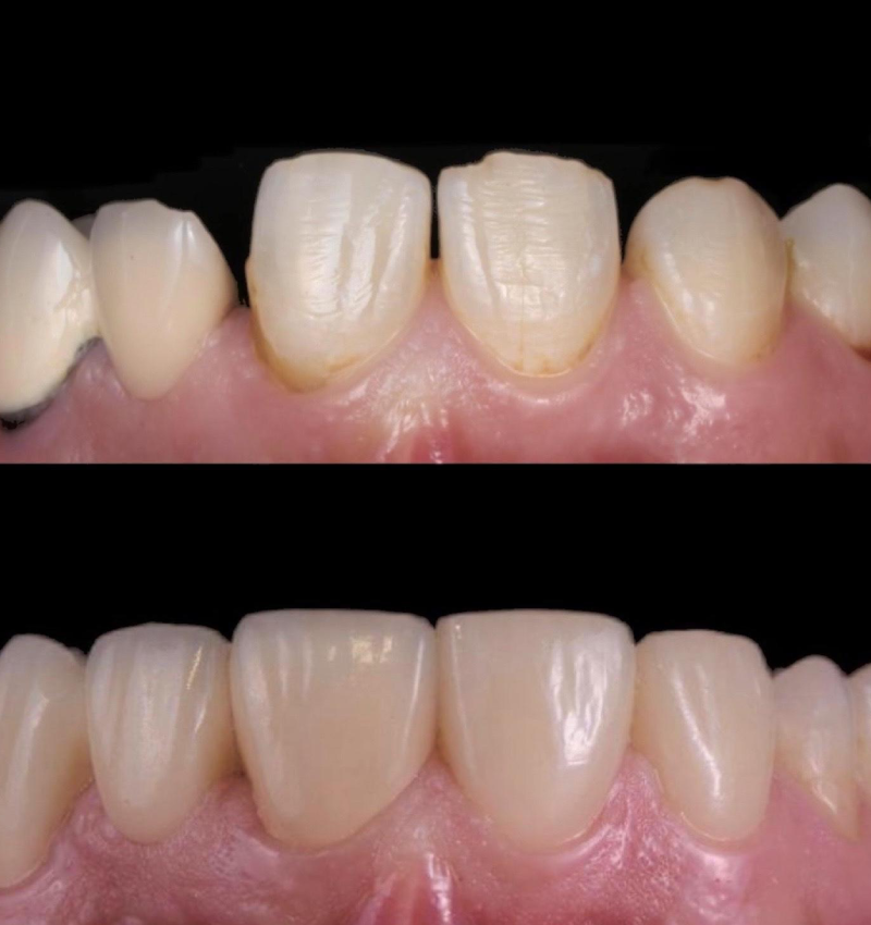Before and After Tooth Crowns and Dental Bridges