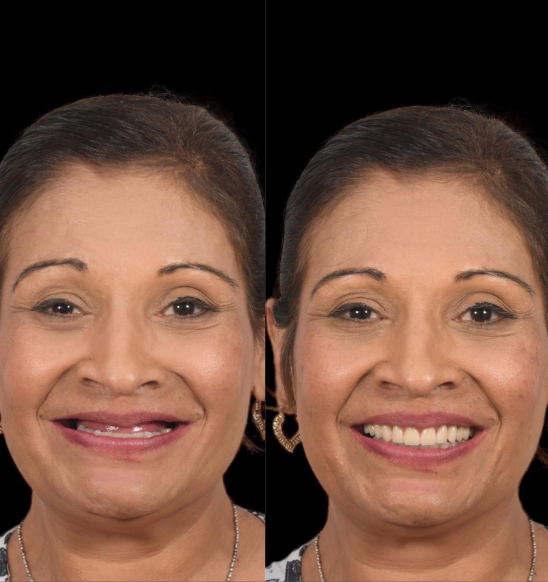 Dentures Before and After