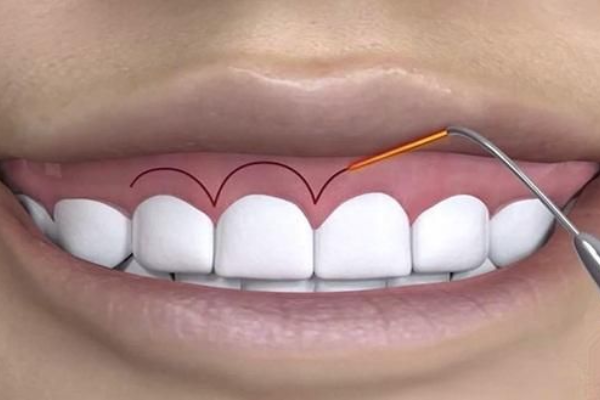 Cosmetic Gum Contouring