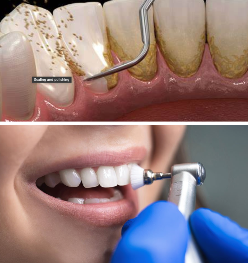 Best Teeth Scaling and Polishing in Abu Dhabi