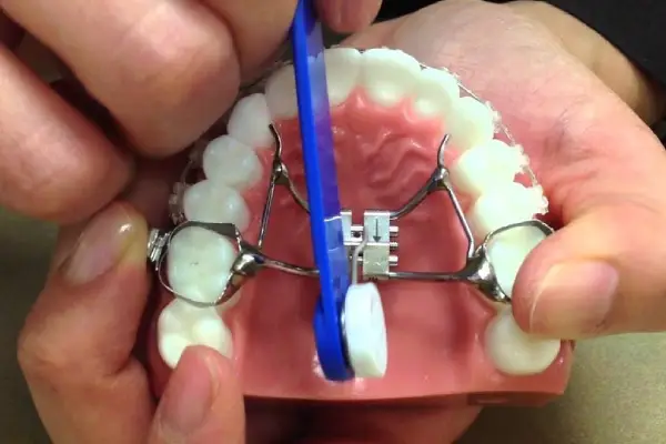 Orthodontic Expanders in Abu Dhabi