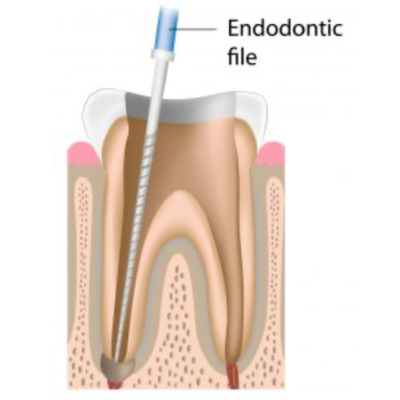 Removal of Broken Instruments in Root Canals
