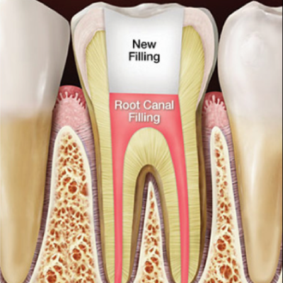 Root Canal Retreatment in Abu Dhabi