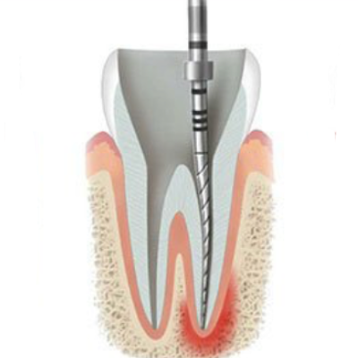 Root Canal Therapy in Abu Dhabi
