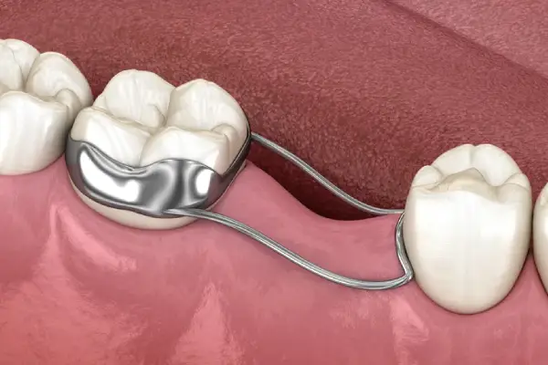 Space Maintainers in Abu Dhabi