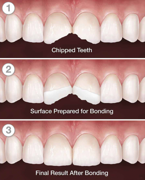 Composite Bonding Process