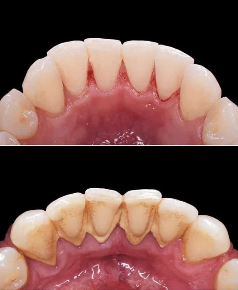 Polishing of Teeth After Scaling