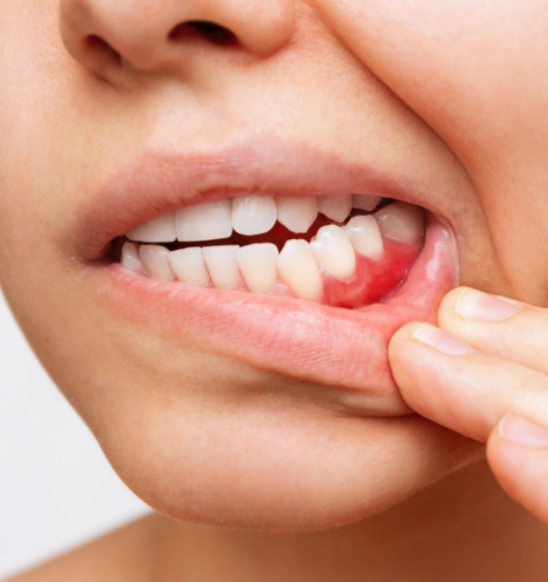 Periodontal Disease Treatment