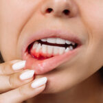 Periodontal (Gum) Disease Causes, Symptoms & Treatment