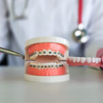 What are the different types of braces