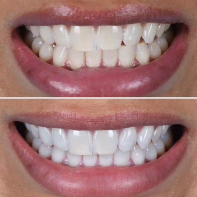 Teeth Bleaching Before and After
