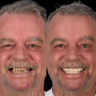 Prosthodontic Treatment in Abu Dhabi