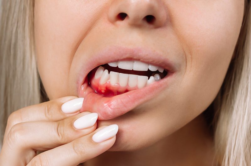 Periodontal (Gum) Disease Causes, Symptoms & Treatment