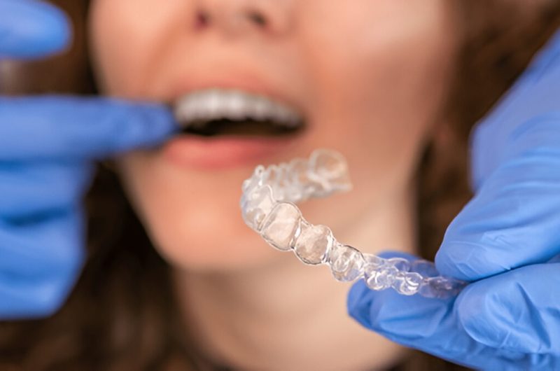 Retainers After Braces Types, Benefits, and How to Take Care